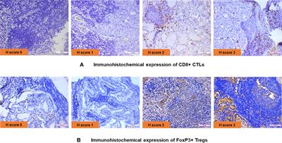 Role of cytotoxic T cells and PD-1 immune checkpoint pathway in papillary thyroid carcinoma